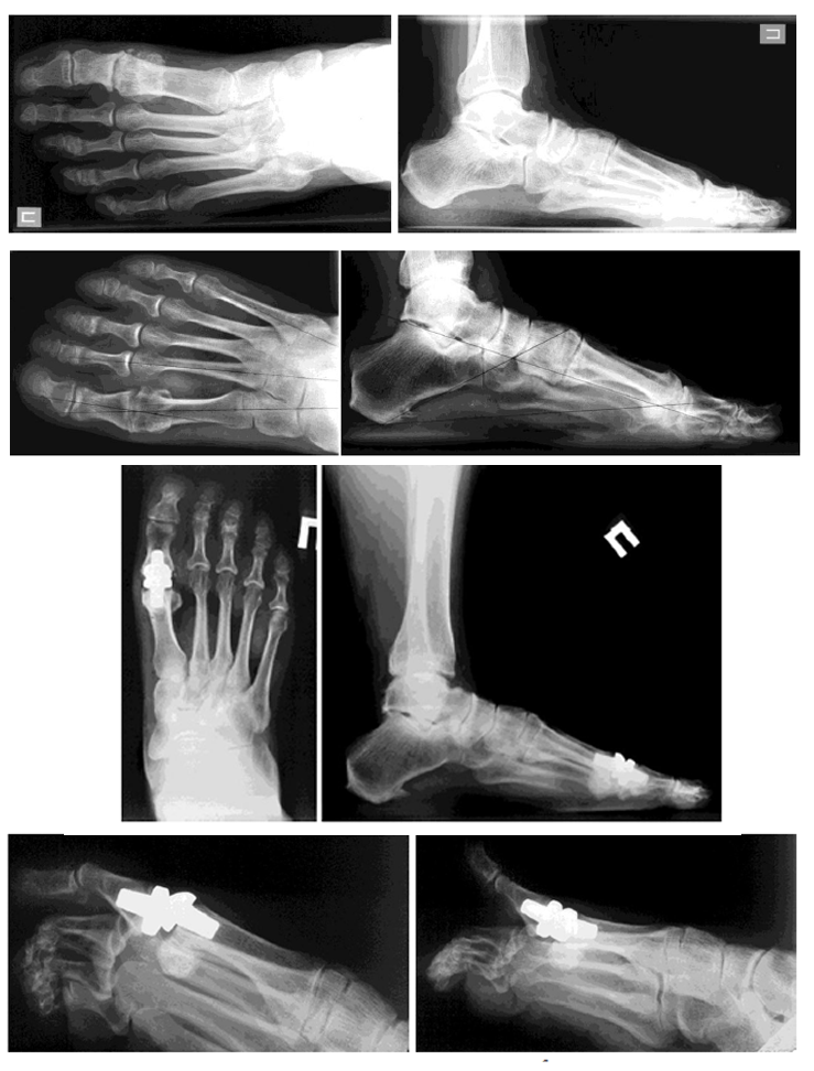 Хирургическое лечение Hallux rigidus