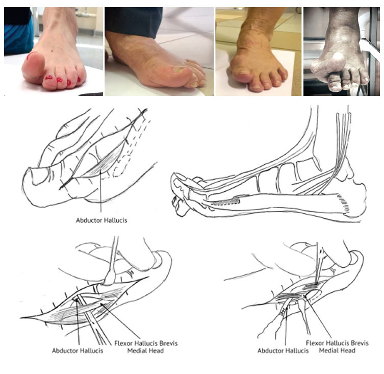 Хирургическое лечение Hallux extensus
