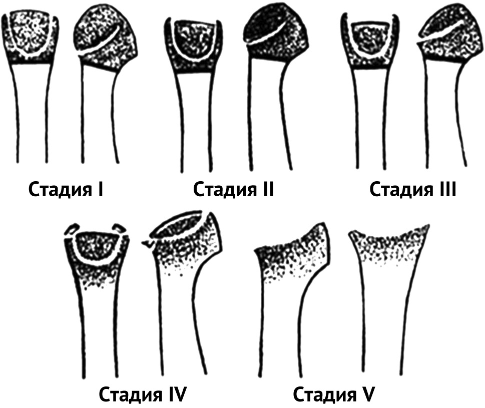 Болезнь Фрайберга-Келера: клиника, диагностика, лечение (обзор литературы)