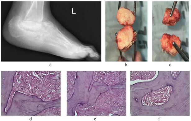 Two-stage replacement of total and subtotal foot bone defects in Charcot neuroosteoarthropathy using personalised allogenic 3D bone bioimplant