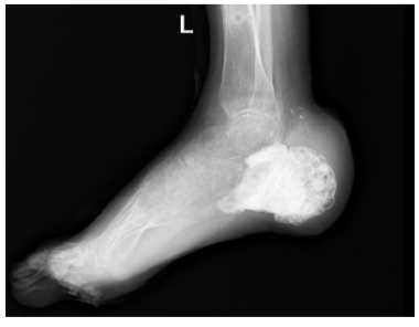 Replacement of Total and Subtotal Defects of the Calcaneus in Patients with Osteomyelitis Using Custom 3D Implants