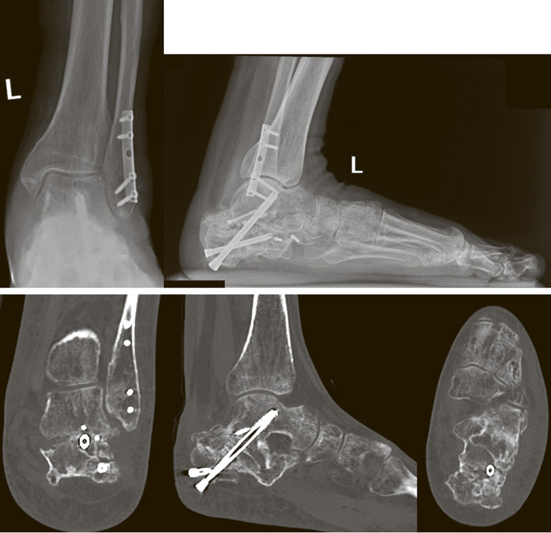 Surgical treatment of type IV Zwipp – Rammelt calcaneal fractures using customized resection templates